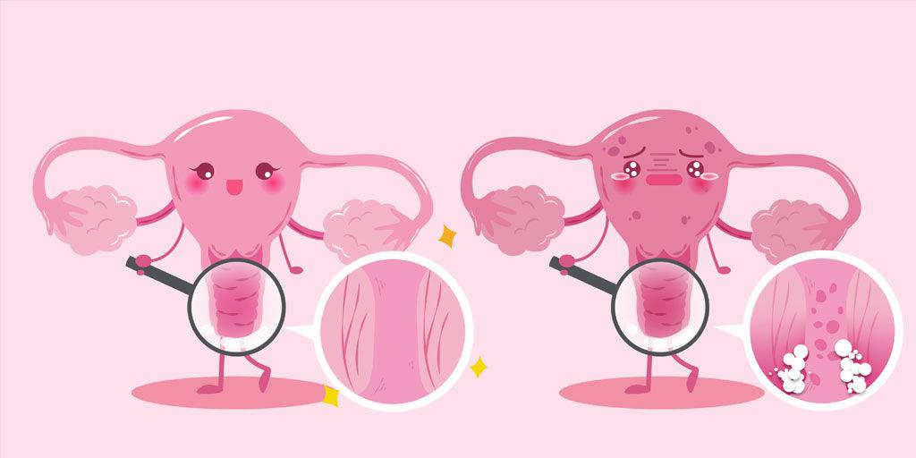 ¿Siempre tienes picazón y ardor allá abajo? puedes estar escondiendo una candidiasis recurrente - Zenzsual 