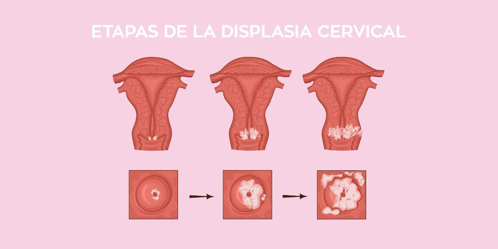 Displasia cervical o lesiones precancerosas en el cuello uterino ¡Puede ser tu caso si no te cuidas! - Zenzsual 