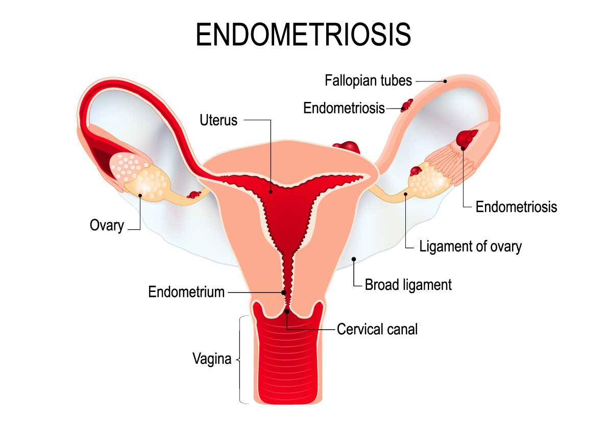 Endometriosis: Si tienes menstruaciones dolorosas e incapacitantes, dolor durante las relaciones sexuales y no has quedado embarazada, puedes estar sufriendo esta enfermedad - Zenzsual 