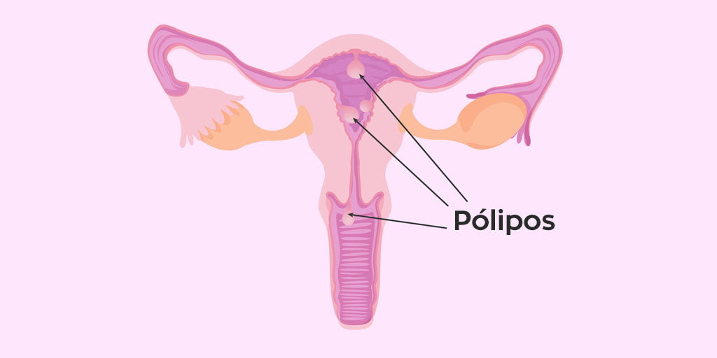 pólipos endometriales
